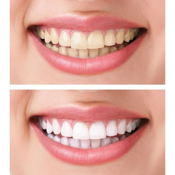 e328569b-9aa7-4d02-981d-c9093f103025.92d3e36c679ad902ad3b054ec73483f0 Sérum blanchissant pour les dents V34